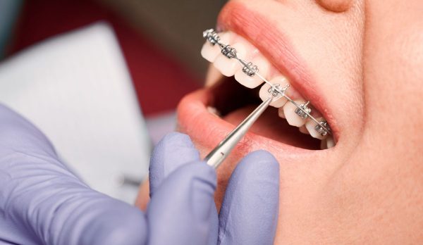 affordableDentalHub-abt Close up of dentist hand in serial glove putting elastic rubber band on patient brackets. Woman with wired metal braces on teeth receiving orthodontic treatment in dental clinic. Concept of dentistry.